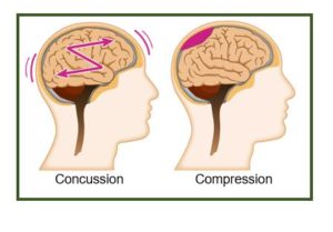 two heads explaining concussion and compression head injury