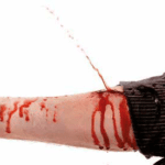 Picture of an arterial bleed which would lead to a severe bleeding injury